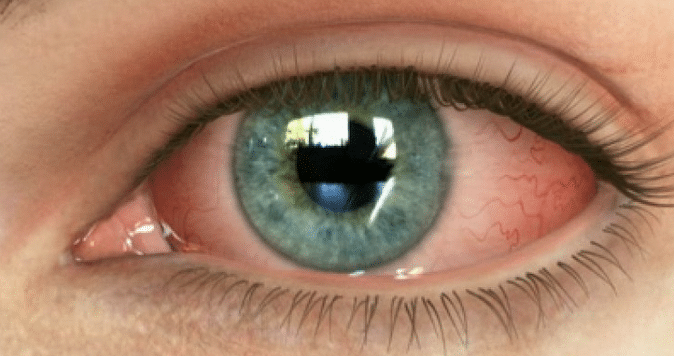 Ожог сетчатки глаз ультрафиолетом thumbnail
